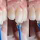 Dental Veneers in Riverside, CA - Magnolia Modern Dental