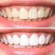 How Much Is Teeth Whitening at Dentist in California