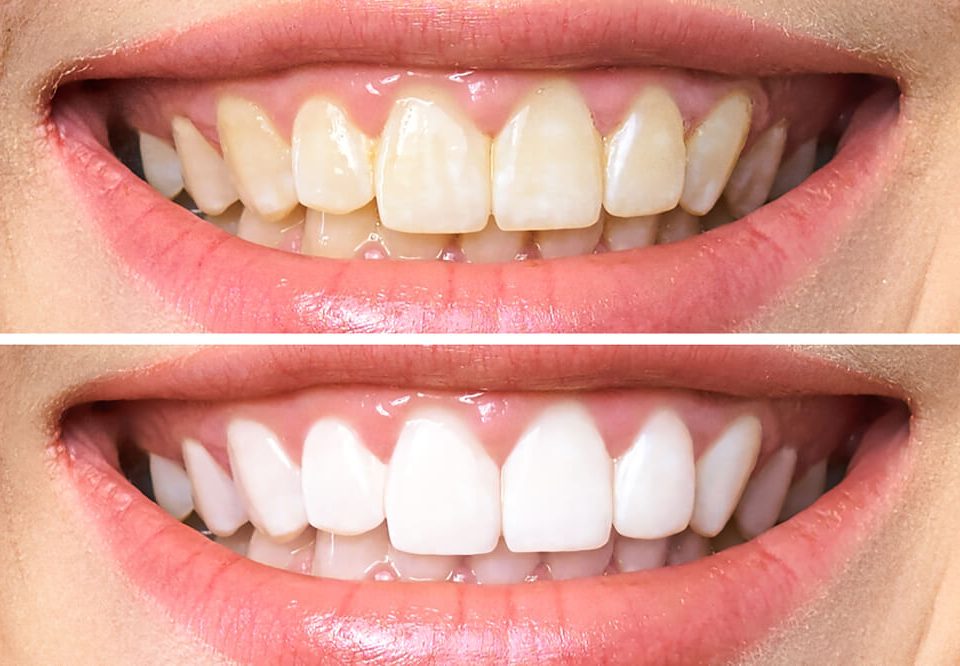 How Much Is Teeth Whitening at Dentist in California